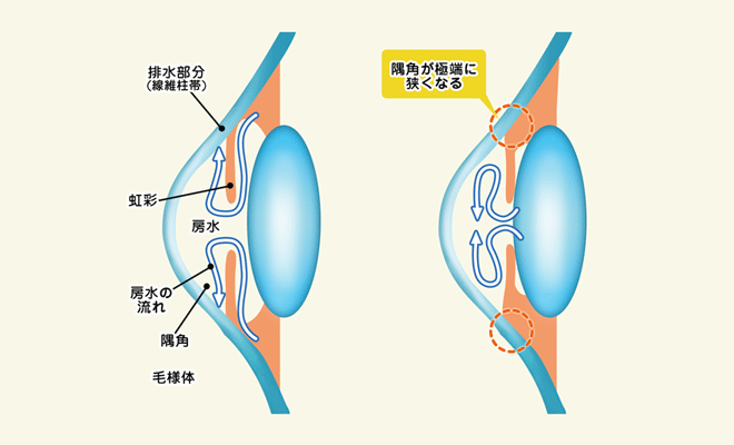 緑内障とは