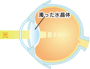 濁った水晶体