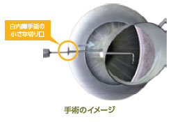 iStent®の手術について
