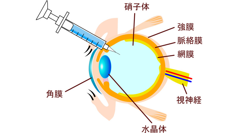 硝子体手術